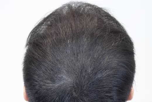 22세 두피문신 3회 1개월 컷 2 사진