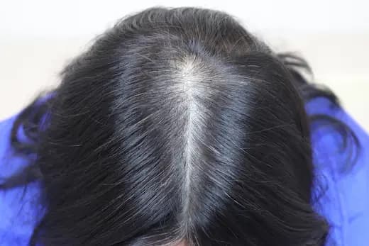 74세 탈모치료 10회 4개월 컷 1 사진