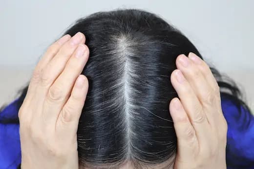 74세 탈모치료 10회 4개월 컷 1 사진