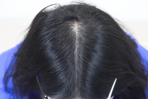 74세 탈모치료 10회 4개월 컷 2 사진