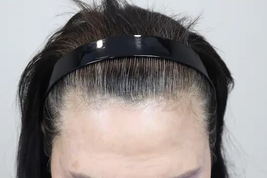 74세 탈모치료 10회 4개월 컷 1 사진