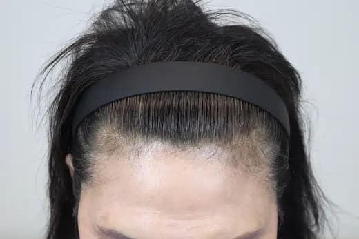 74세 탈모치료 10회 4개월 컷 2 사진