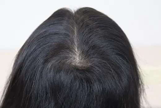 74세 탈모치료 10회 4개월 컷 2 사진