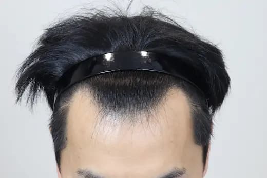 39세 모발이식 2500모 12개월 전 사진