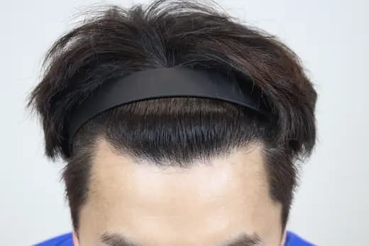39세 모발이식 2500모 12개월 후 사진