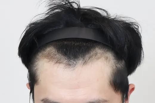 35세 모발이식 3000모 9개월 전 사진