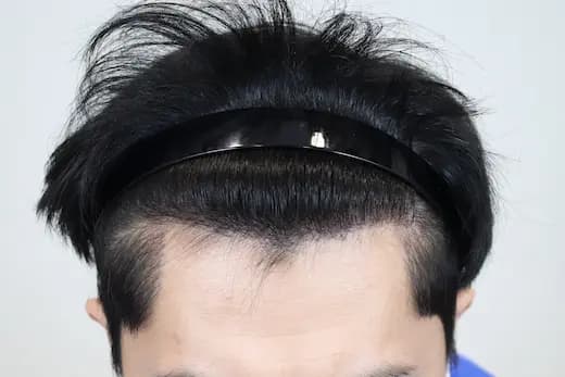 35세 모발이식 3000모 9개월 후 사진