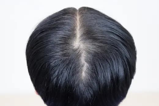 33세 두피문신 6회 3개월 컷 1 사진