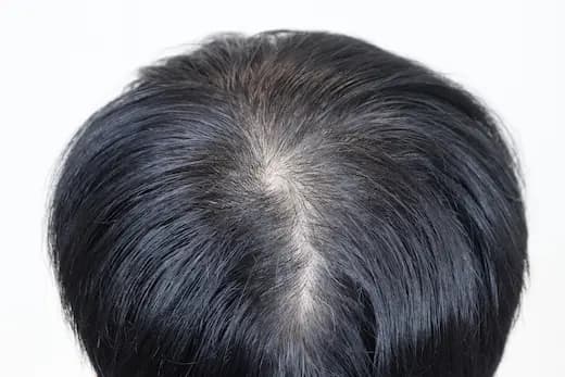 33세 두피문신 6회 3개월 컷 1 사진