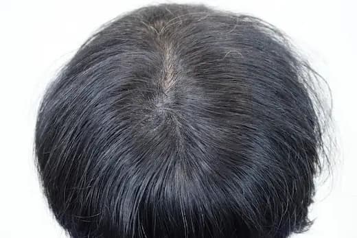 33세 두피문신 6회 3개월 컷 2 사진