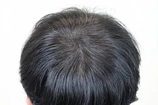 33세 두피문신 6회 3개월 컷 2 사진