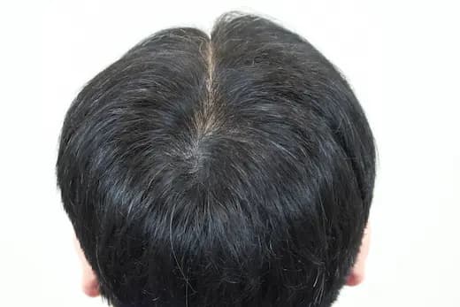 33세 탈모치료 10회 두피문신 6회 6개월 컷 2 사진