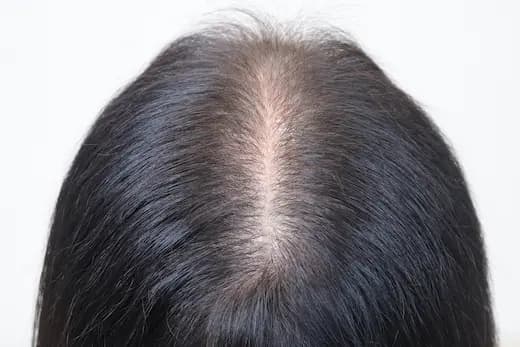 38세 탈모치료 10회 4개월 전 사진