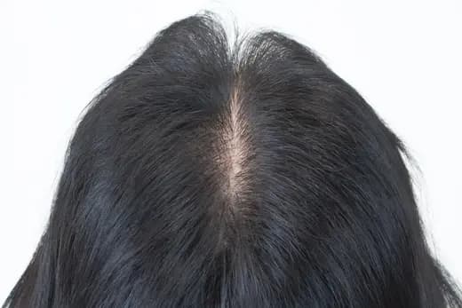 38세 탈모치료 10회 4개월 후 사진