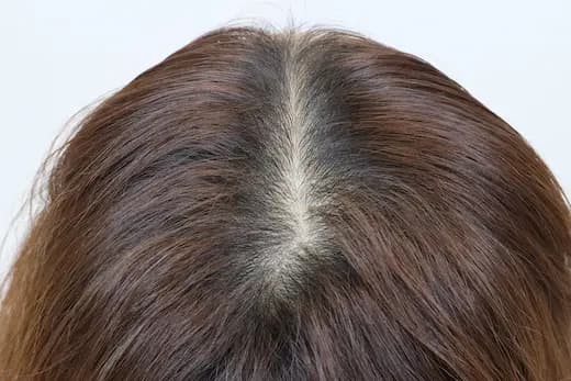 45세 탈모치료 10회 5개월 컷 1 사진