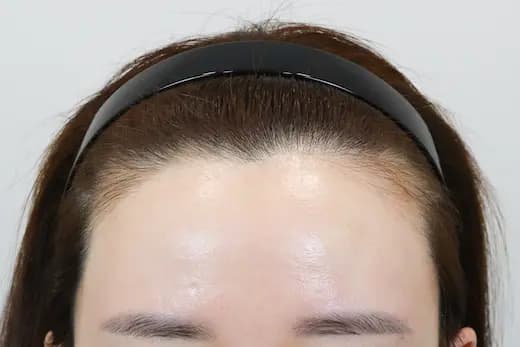 31세 모발이식 2000모 6개월 컷 1 사진