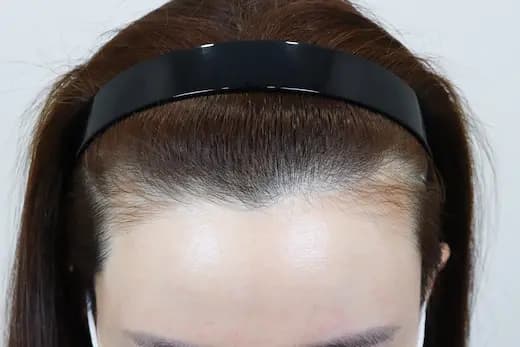 31세 모발이식 2000모 6개월 컷 1 사진