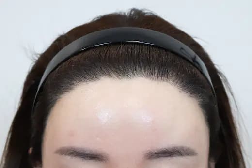 31세 모발이식 2000모 6개월 컷 2 사진