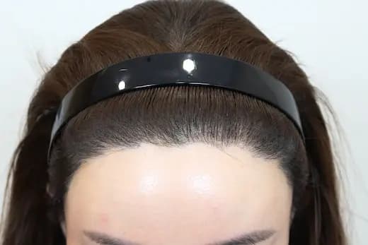 31세 모발이식 2000모 6개월 컷 2 사진