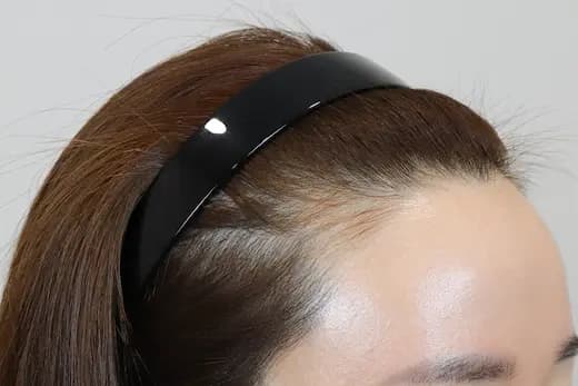 31세 모발이식 2000모 6개월 컷 1 사진