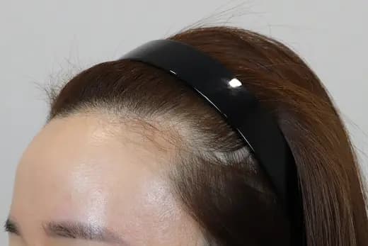 31세 모발이식 2000모 6개월 컷 1 사진