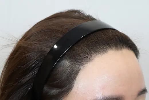 31세 모발이식 2000모 6개월 컷 2 사진