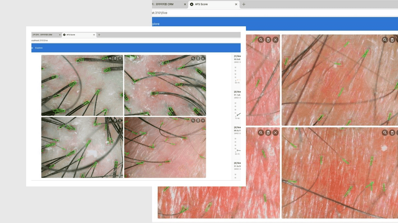탈모진단 인공지능 AFS Score로 정확하게