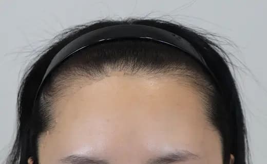 25세 모발이식 2500모 6개월 전 사진