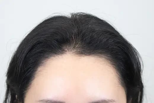 25세 모발이식 2500모 6개월 후 사진