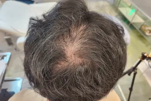 47세 두피문신 6회 2개월 전 사진