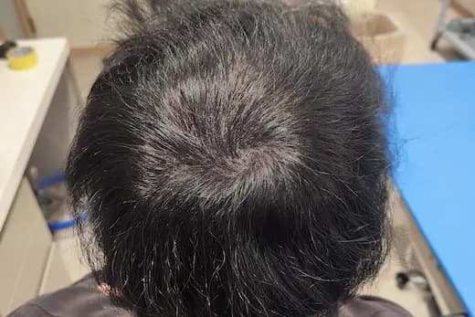 47세 두피문신 6회 2개월 후 사진
