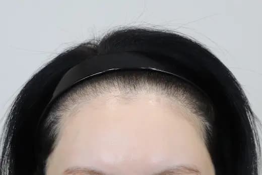 두피문신 헤어라인