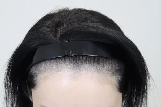 36세 탈모치료 10회 두피문신 5회 4개월 전 사진