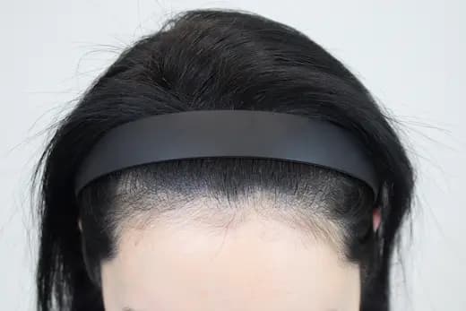 36세 탈모치료 10회 두피문신 5회 4개월 후 사진